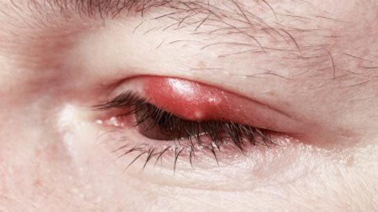 Göz Mikrobu Belirtileri ve Tedavisi